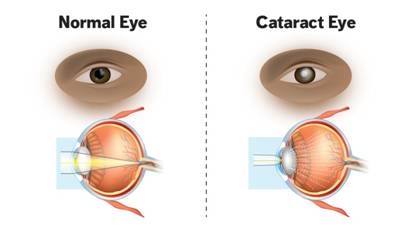 What Are Cataracts? Understanding Symptoms and Treatment