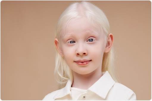 Genetics of Albinism