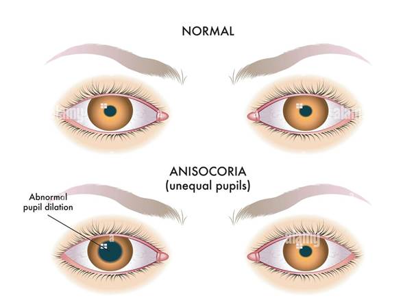 vector medical illustration of the symptoms of unequal pupils, also called  anisocoria Stock Vector Image & Art - Alamy