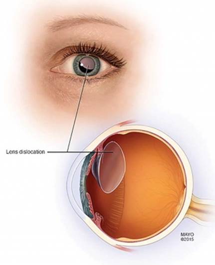 Pediatric Aphakia And Where To Place An Intraocular Lens | Children's  Hospital of Philadelphia