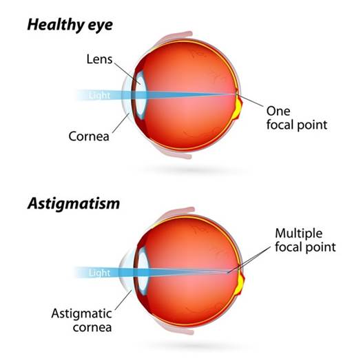 Astigmatism - Common Eye Condition