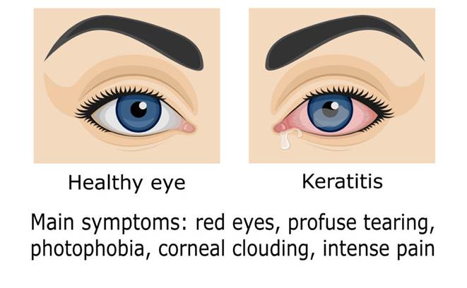 What to Know About Keratitis: Dangers, Symptoms, Treatment | NVISION Eye  Centers