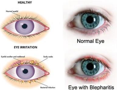 Blepharitis – Ophthalmologist, Retina Specialist treating patients in  Sherman, Denison, Durant, Bonham, Paris, Gainesville, Mckinney