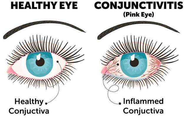 Conjunctivitis (Pink Eye) Causes and Treatment | Wolfe Eye Clinic
