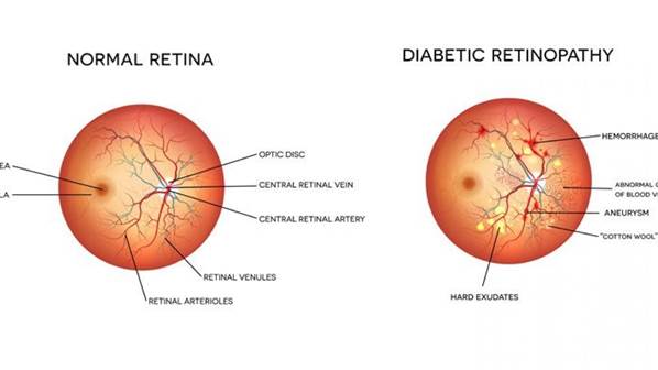 Understanding Diabetic Retinopathy and how to reverse it