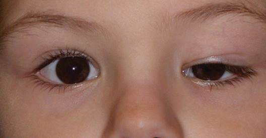 Childhood eyelid ptosis: Symptoms and treatments | IMO