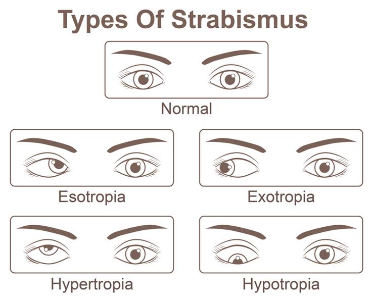 Strabismus (Crossed Eyes): Treatment Options in 2022 | NVISION Eye Centers