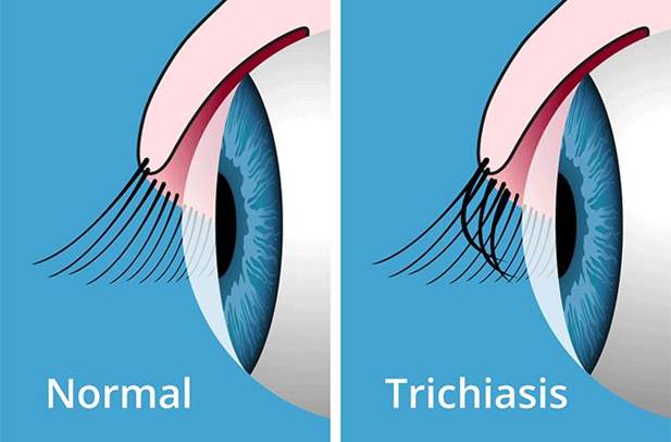 Trichiasis (Ingrown Eyelashes) - All About Vision