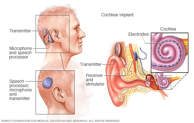 How cochlear implants work