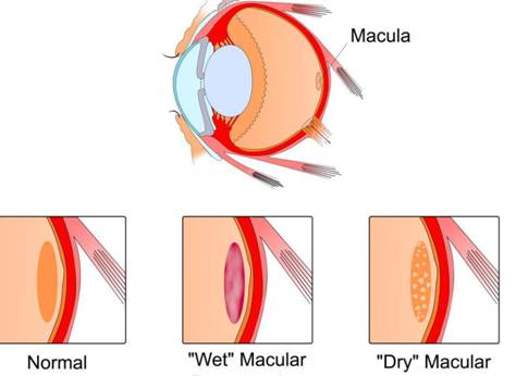 Age-Related Macular Degeneration: Beverly Hills Institute of ...
