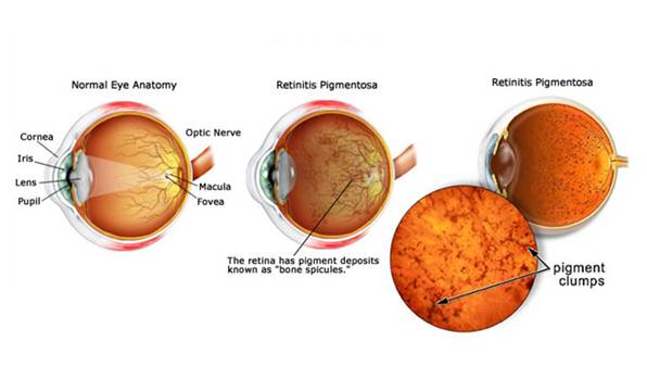 What is Retinitis Pigmentosa: Exploring the Causes & Symptoms ...