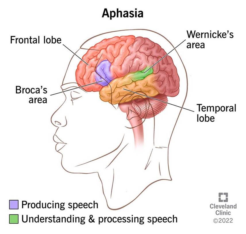 Aphasia affects areas of the brain that control your ability to speak and the words you use or how you understand them.